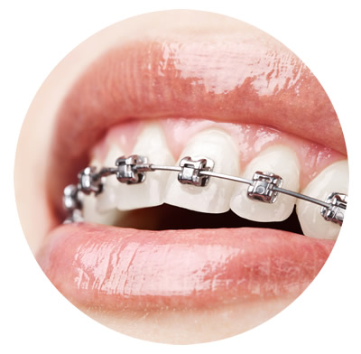 Como cuidar do seu aparelho e dos seus dentes durante um tratamento ortodôntico