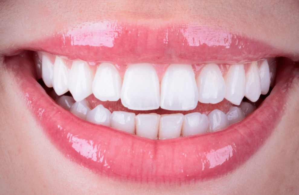 5 causas do amarelamento dos dentes