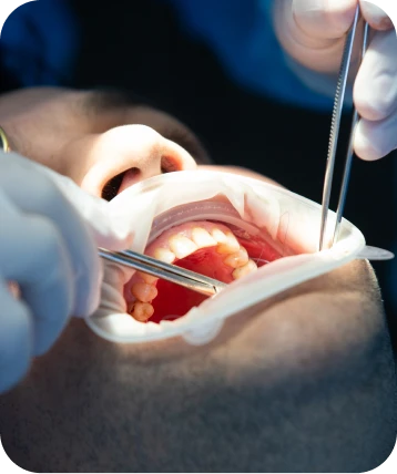 Procedimento odontológico sendo realizado por dentista especialista em implantes na Clínica OdontoQuality em Tijucas.