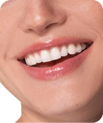 Sorriso bonito após tratamento odontológico estético na Clínica OdontoQuality em Tijucas.