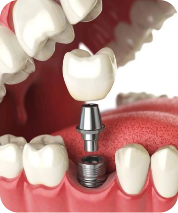 Ilustração de implante dentário mostrando a fixação da coroa sobre o pino de titânio, tratamento realizado na Clínica OdontoQuality em Tijucas.